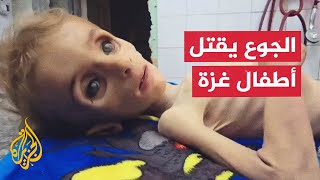 وفاة طفلة بسبب سوء التغذية في دير البلح