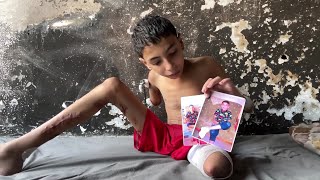 الطفل سمير زقوت من غزة فقد ساقه وذراعه بالعدوان الإسرائيلي ويحلم باستكمال علاجه وتركيب طرفين صناعيين