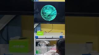 Patient Couldn’t Hear – ENT Fixes It Fast! 👨⚕️🧼 #EarwaxClean #EarScope #ent