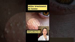 Milia treatment at home /100%effective👌🏻#skincare #shorts #trending #viral #skincaretips