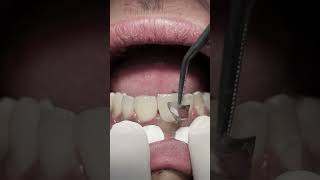 Composite restoration for anterior teeth #dentist #shorts