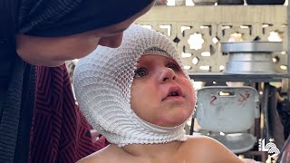 الرضيع محمد حجيلة مصاب بحروق خطيرة ومحروم من العلاج بسبب الحصار الإسرائيلي على غزة