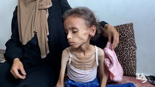 تدهور الحالة الصحية للطفلة مريم دواس بسبب سوء التغذية ونقص المساعدات واستمرار الحرب في غزة