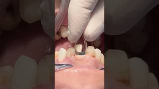 Replace old composite restoration to anterior teeth #dentist #dental