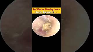 Ear Wax vs. Hearing Loss - Doctor Explains 🔇👂 #EarWax #HearingHealth #ENT