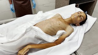 عاطف أبو خاطر ضحية جديدة لسوء التغذية المتفشية في قطاع غزة