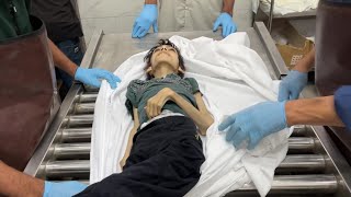 وفاة الشقيقين حنان ومحمود الضبة نتيجة سوء التغذية في غزة