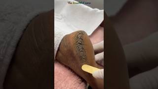 Pedicure extraction foot cleaning