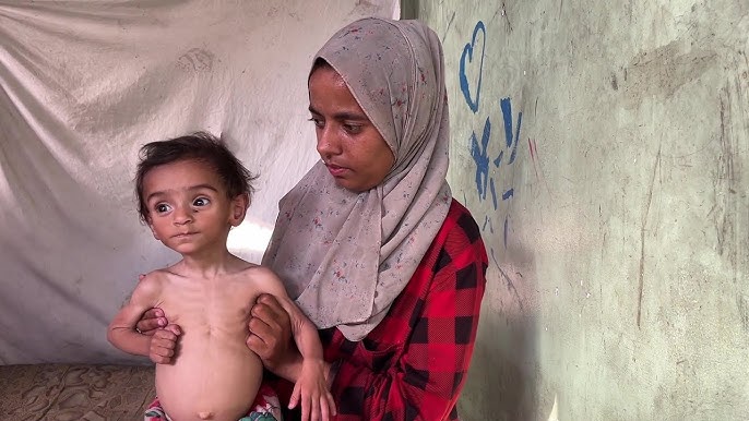 الرضيع عدي حبيب من غزة استشهد والداه وسوء التغذية يهدّد حياته
