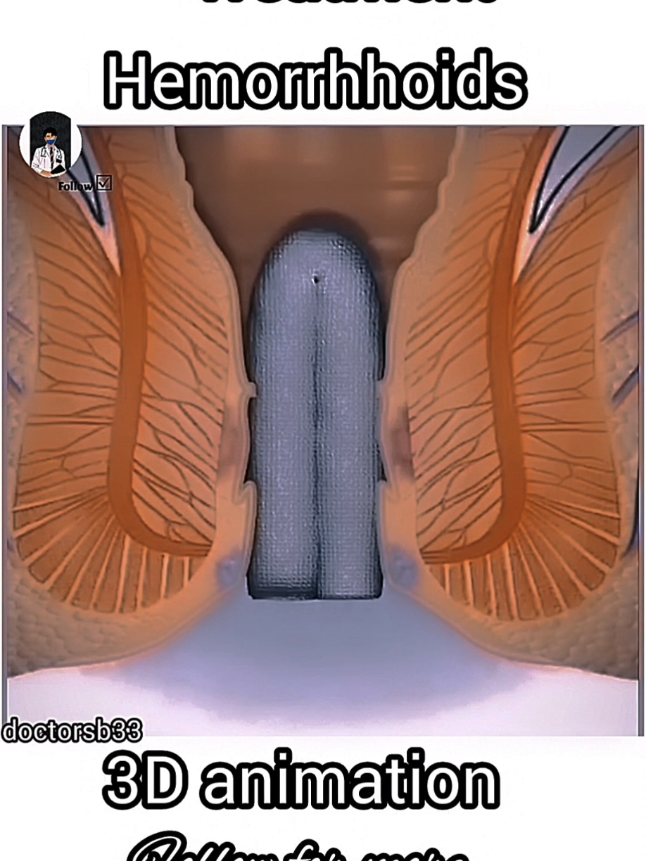 hemorrhhoids treatment #foruyou #forupage #10millionviews #tiktokviral #onlyforyou #videos @Doctor sb 🩺 @MBBS Doctor @Doctor sb 🥼 @MBBS DR 🥼